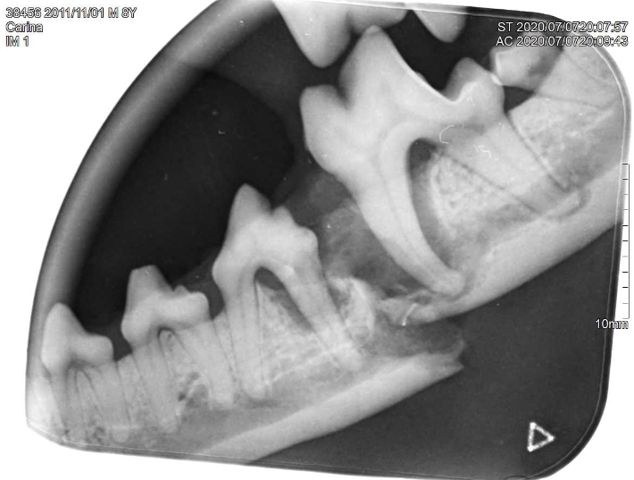 Dentalröntgen Kieferfraktur